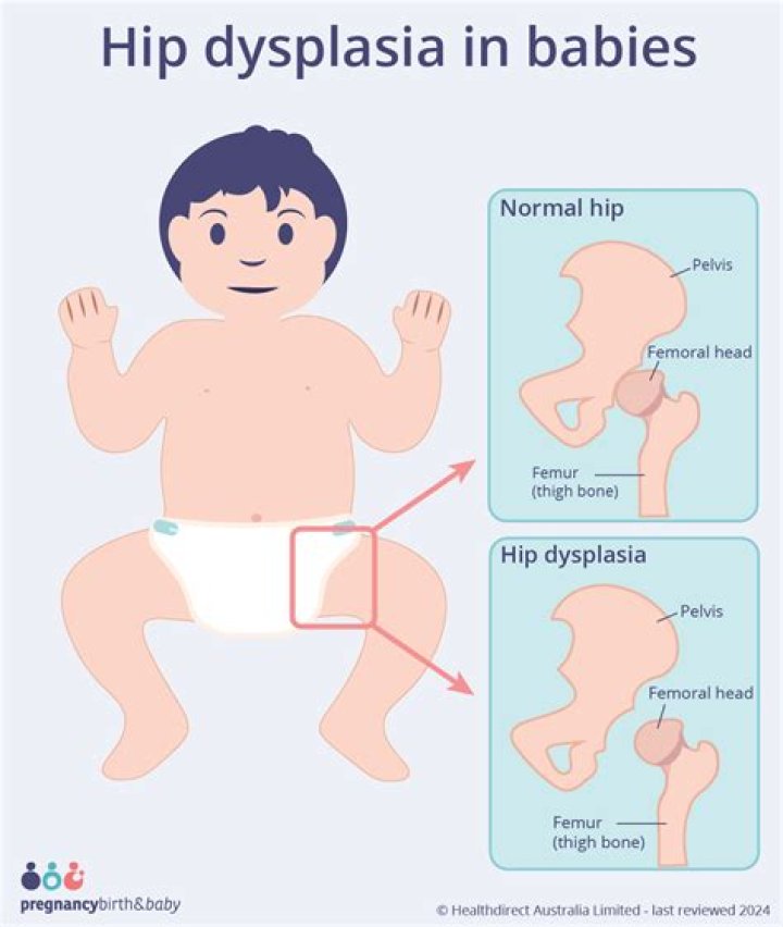 At what age is hip dysplasia diagnosed?