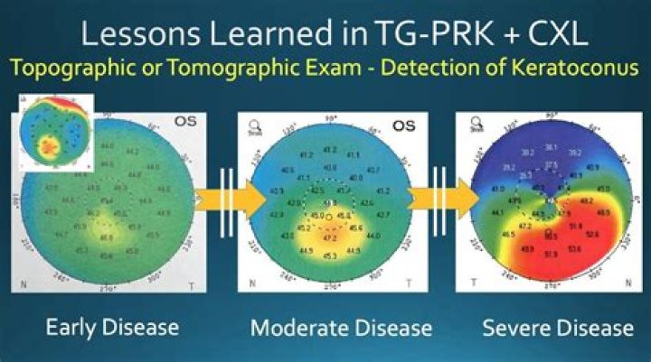 Can I get disability for keratoconus?