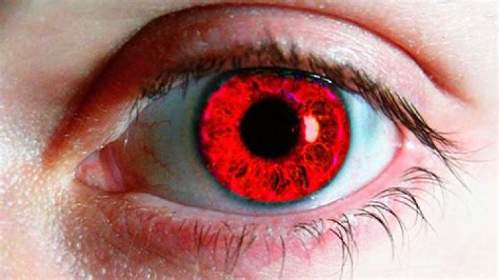 Can people be born with red eyes?