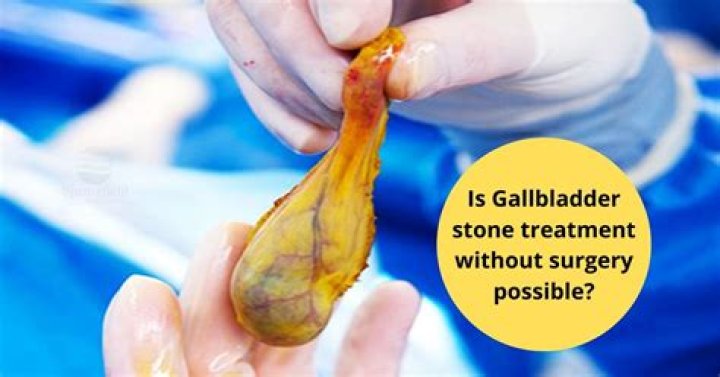 Can they remove gallstones without removing the gallbladder?