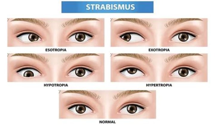 Can TV cause strabismus?
