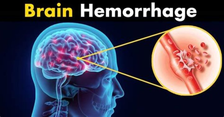 Can you fully recover from a brain hemorrhage?