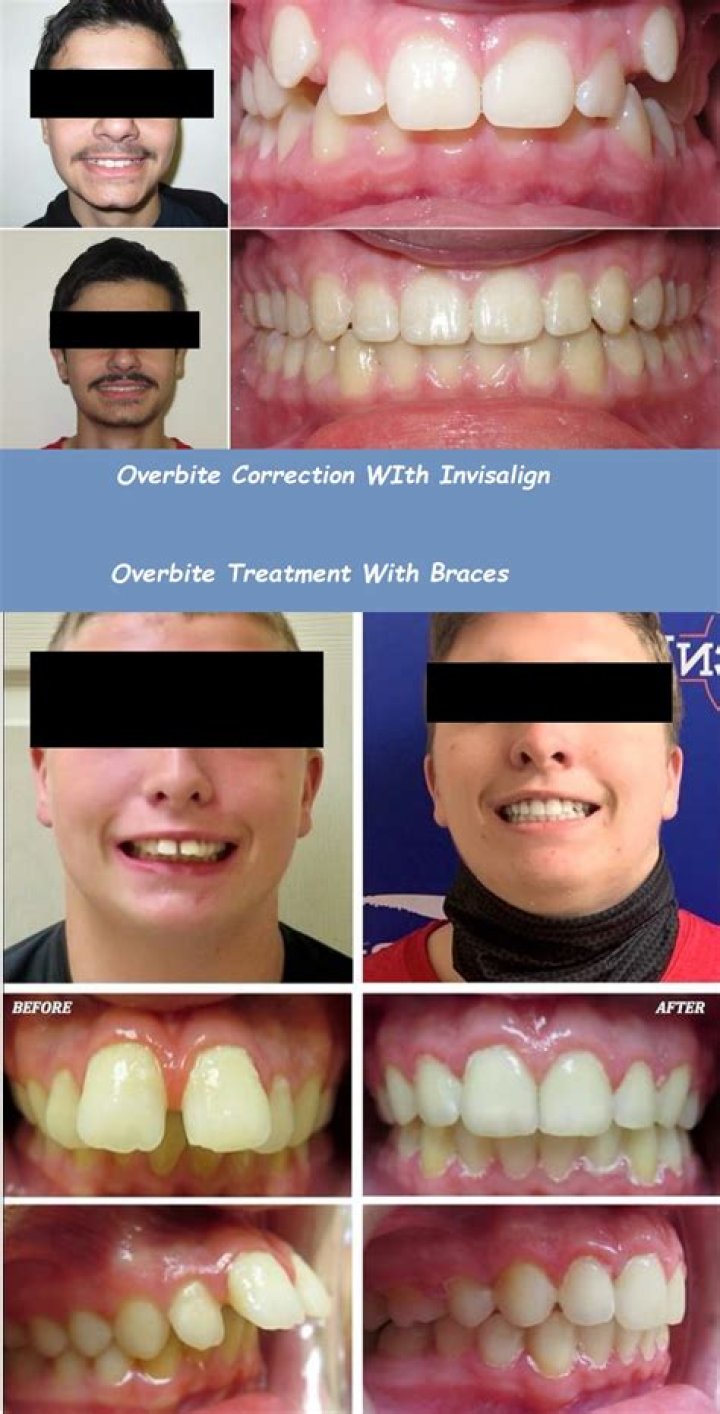 Can you Juul with Invisalign?