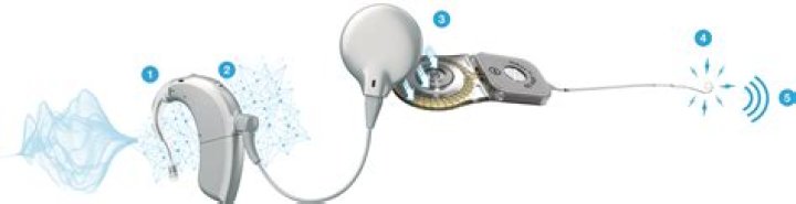 Does a cochlear implant have a speech processor?