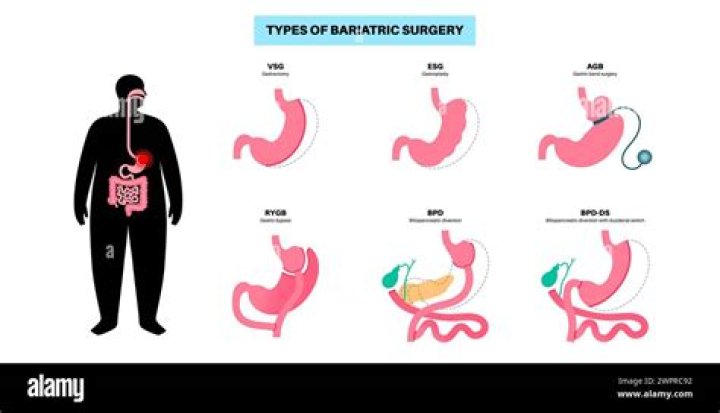 Does bariatric surgery include skin removal?