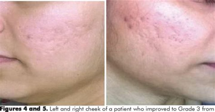 Does microneedling help atrophic scars?