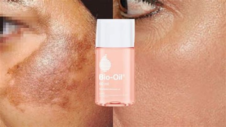 Does olive oil remove dark spots?