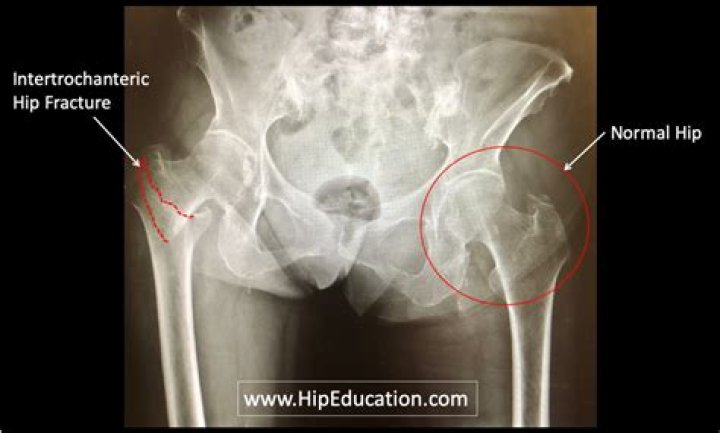 How can I help my mother with a broken hip?