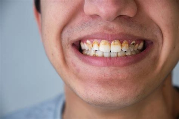 How do you get build up off teeth?