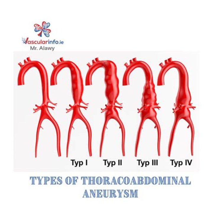 How long can you live after thoracic aortic aneurysm?