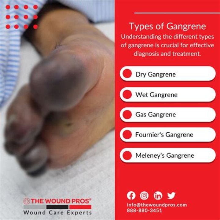 How long can you live with gangrene?