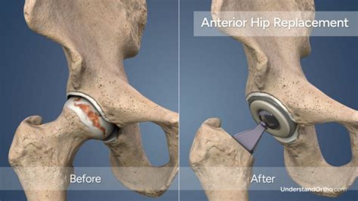 How long do people live after a hip replacement?