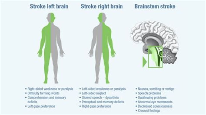 How long does it take to recover from a stroke on the right side?