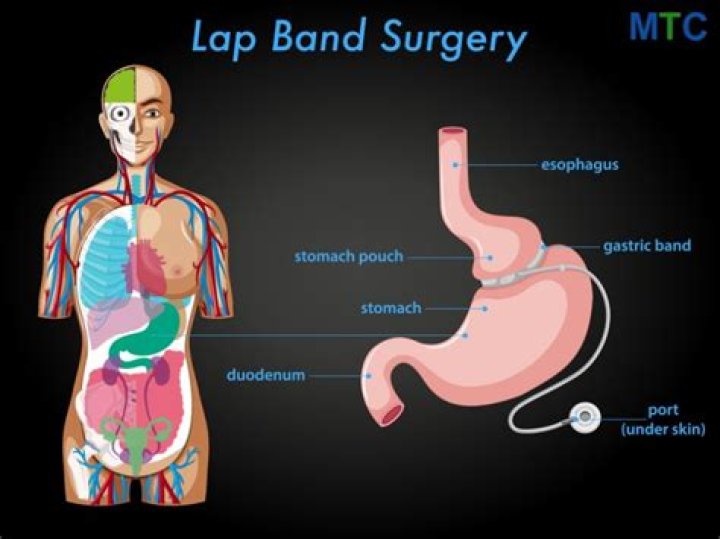 How much does lap band surgery cost out of pocket?