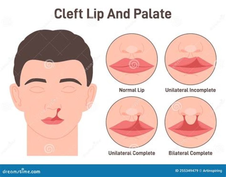 Is cleft lip repair covered by insurance?