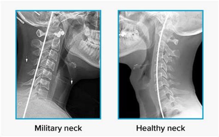 Is military neck a disability?