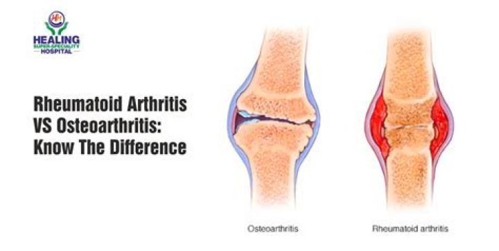 Is osteoarthritis damage reversible?