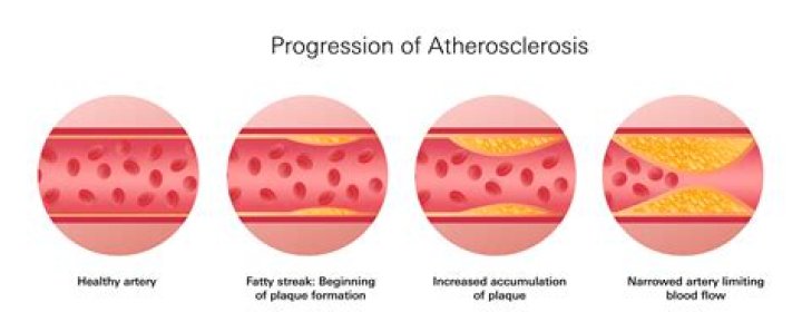 What are symptoms of atherosclerosis in the iliac or femoral arteries?