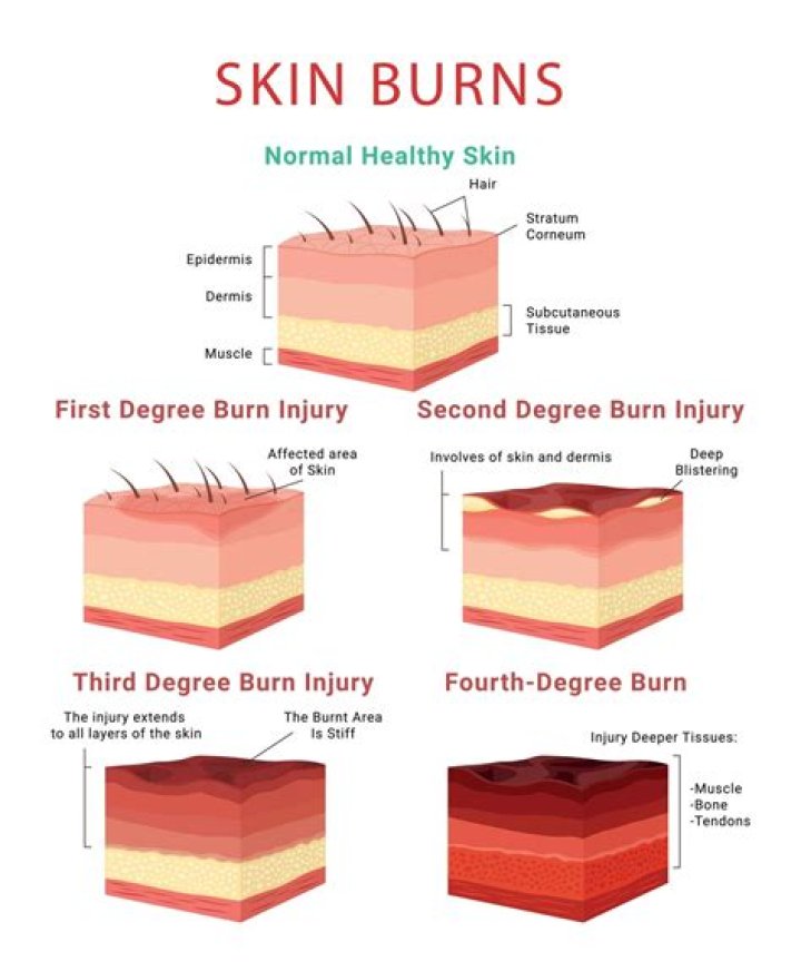 What are the 3 stages of burns?