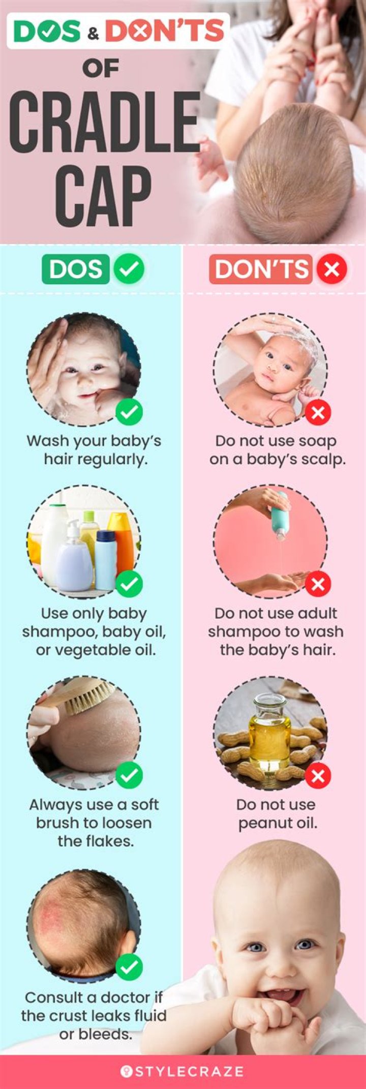 What can you do about cradle cap?