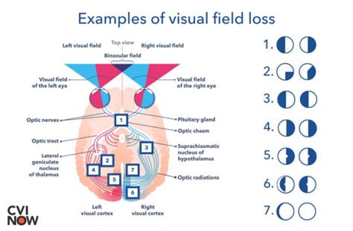 What causes loss of vision in left eye?