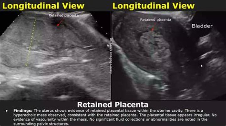 What is a retained life interest?
