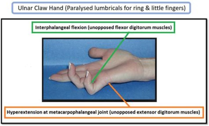 What is anti ring claw?