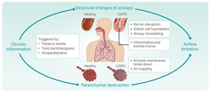 What is considered a chronic respiratory disease?