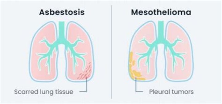 What is the average settlement for asbestosis?