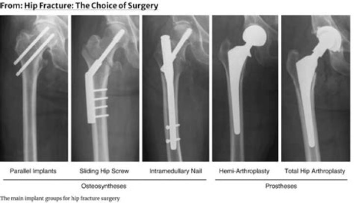 What is the most common and significant complication following hip fracture?