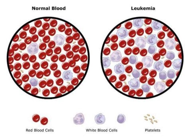 What level of WBC indicates leukemia?