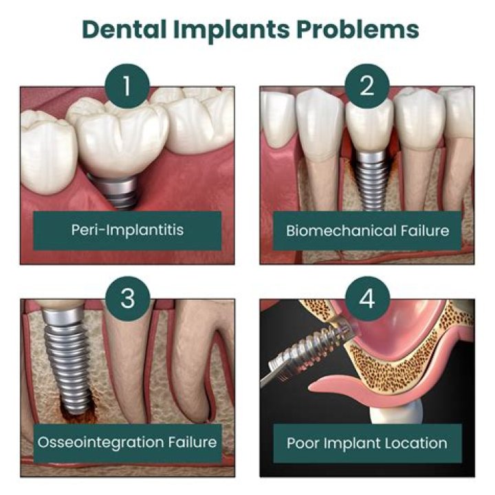 When was the first dental implant performed?