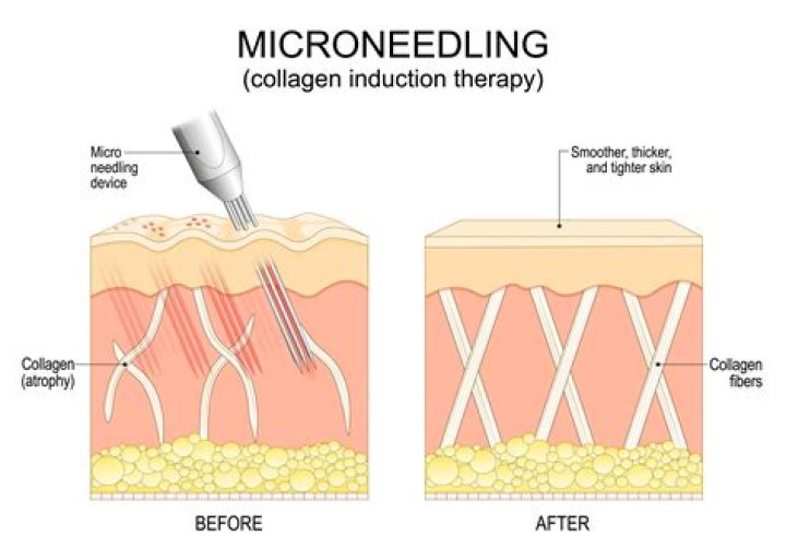 Which is better plasma pen or microneedling?