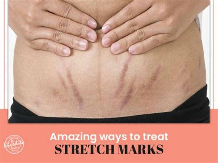 Why do I have stretch marks on my hips?