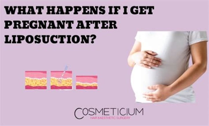 Why do I look pregnant after liposuction?