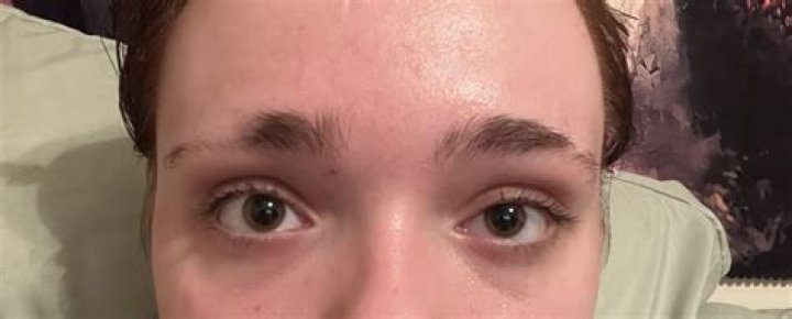 Why have half my eyebrows disappeared?
